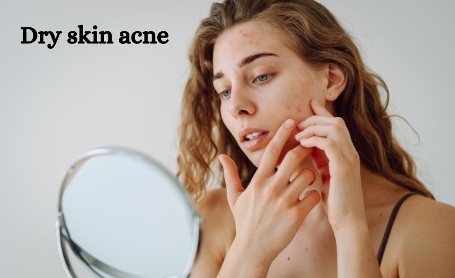 dry skin acne