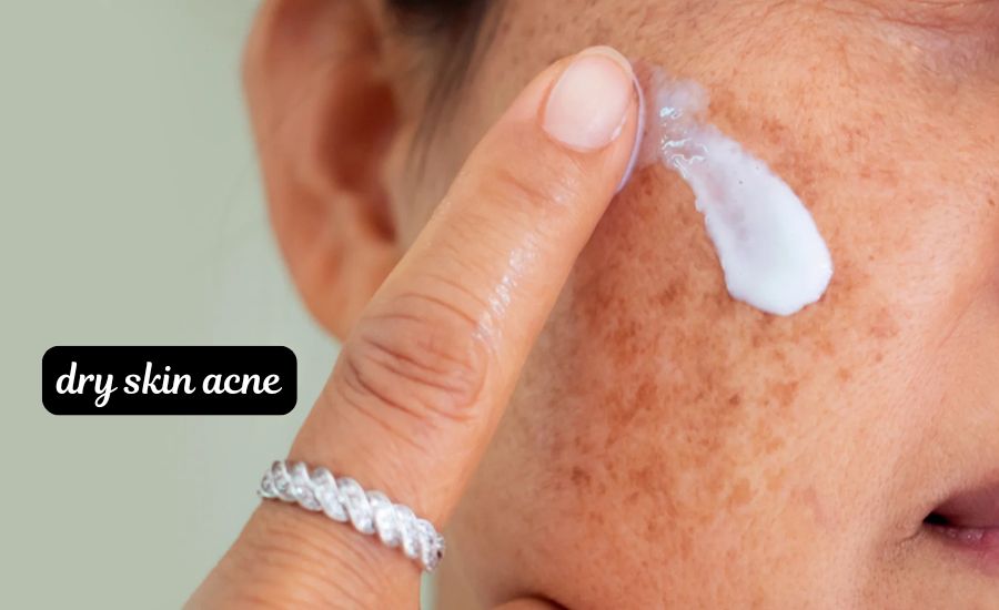 dry skin acne